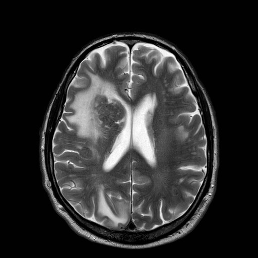 File:Brain metastases from lung cancer (Radiopaedia 83839-99028 Axial T2 22).jpg