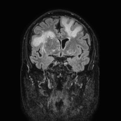 File:Brain metastases from lung cancer (Radiopaedia 83839-99028 Coronal FLAIR 32).jpg