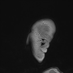 Brain metastasis (Radiopaedia 42617-45761 Sagittal T1 C+ 96).jpg