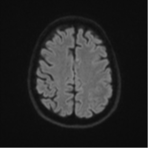 Brain metastasis (large cystic mass) (Radiopaedia 47497-52107 Axial DWI 48).png