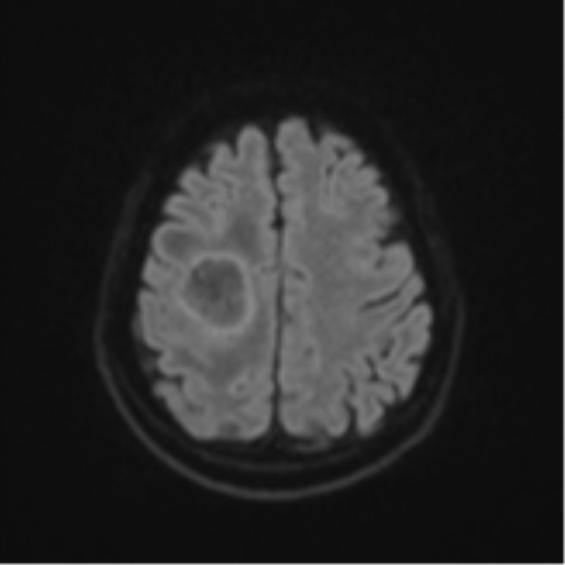 Brain metastasis (sarcoma) (Radiopaedia 47576-52209 Axial DWI 48).png