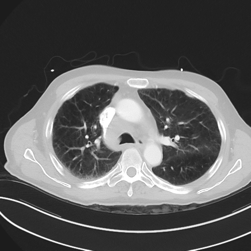 File:Brain metastasis from lung cancer (Radiopaedia 48289-53180 Axial 74).png