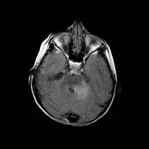 File:Brainstem ganglioglioma (Radiopaedia 10763-11224 Axial FLAIR 14).jpg