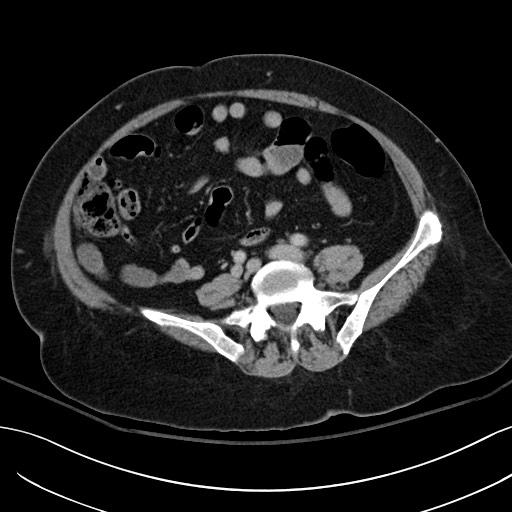 File:Breast carcinoma with pathological hip fracture (Radiopaedia 60314-67974 B 47).jpg