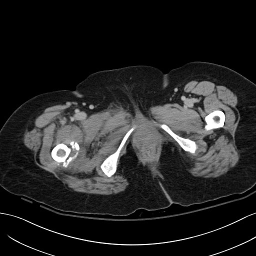 Breast carcinoma with pathological hip fracture (Radiopaedia 60314-67974 B 78).jpg
