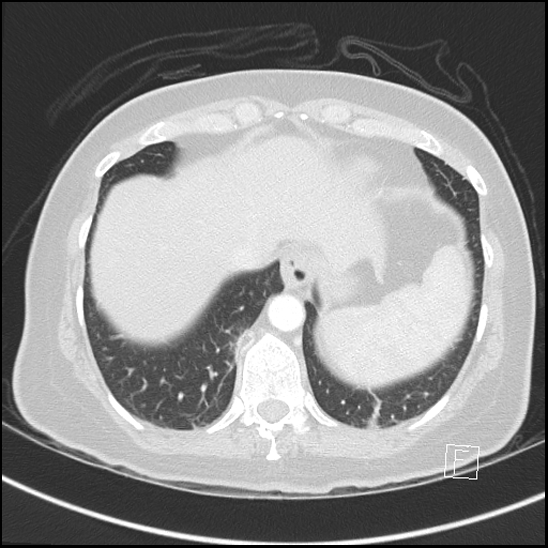 Breast metastases from renal cell cancer (Radiopaedia 79220-92225 Axial lung window 71).jpg