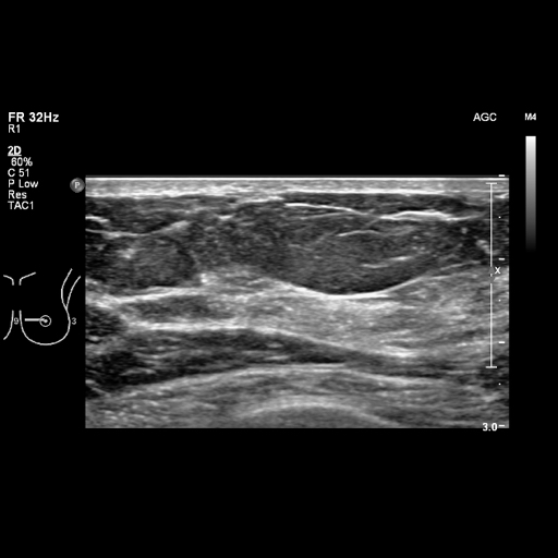 File:Breast metastases from renal cell cancer (Radiopaedia 79220-92226 Left breast US 25).jpeg