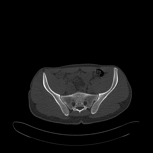 Brodie abscess- femoral neck (Radiopaedia 53862-59966 Axial bone window 53).jpg