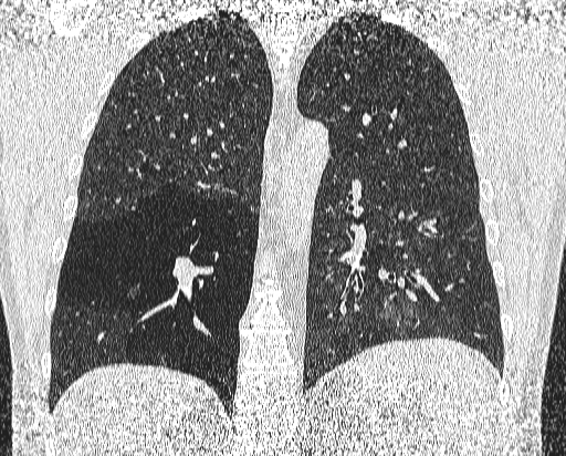 Bronchial atresia (Radiopaedia 58271-65417 Coronal lung window 39).jpg