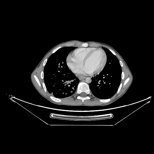 Bronchial carcinoid tumor (Radiopaedia 57187-64090 A 54).jpg
