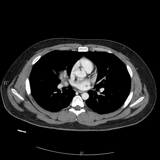 Bronchial carcinoid tumor (Radiopaedia 78272-90875 A 52).jpg