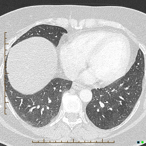 File:Bronchial diverticula (Radiopaedia 79512-92676 Axial lung window 147).jpg