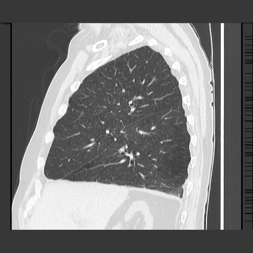 Bronchial stenosis - lung transplant (Radiopaedia 73133-83848 Sagittal lung window 23).jpg