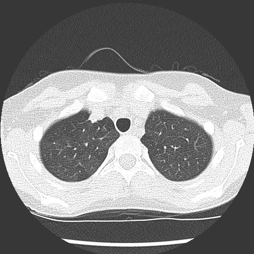 Bronchiolotis obliterans (Radiopaedia 73769-84575 Axial lung window 9).jpg
