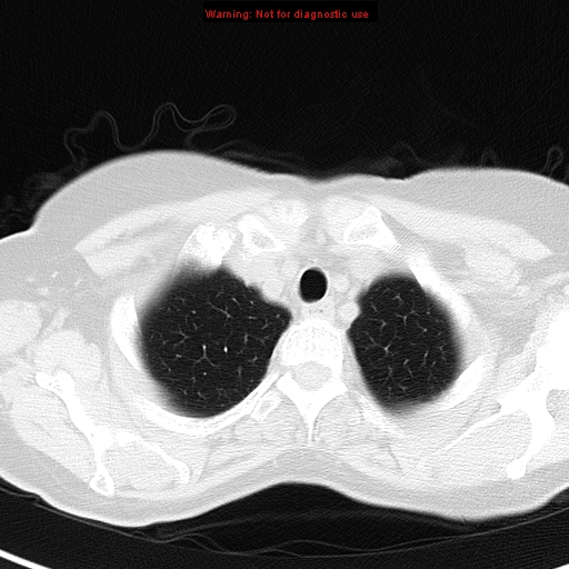 File:Bronchoalveolar carcinoma (BAC) (Radiopaedia 13436-13392 Axial lung window 6).jpg