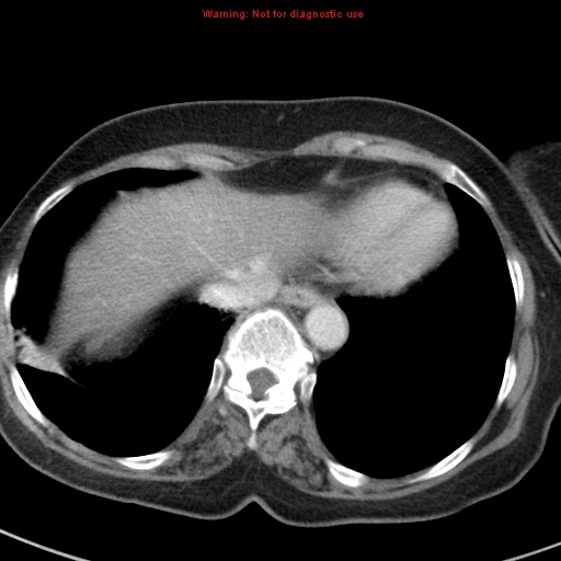 File:Bronchoalveolar carcinoma (BAC) (Radiopaedia 13436-13392 B 43).jpg