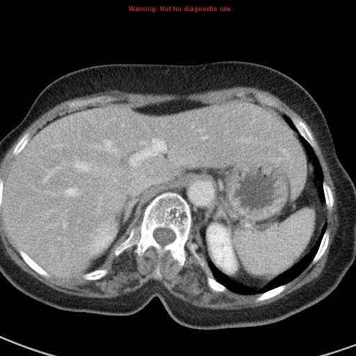 File:Bronchoalveolar carcinoma (BAC) (Radiopaedia 13436-13392 B 50).jpg