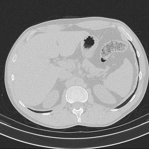Bronchocele (Radiopaedia 60676-68429 Axial lung window 74).jpg