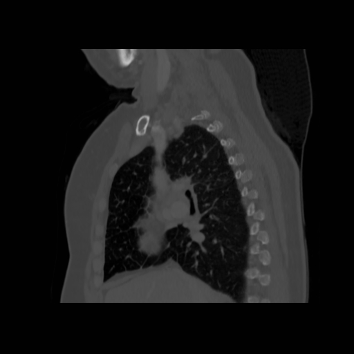 Bronchogenic carcinoma (Radiopaedia 73497-84262 Sagittal bone window 68).jpg