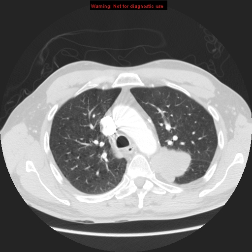 File:Bronchogenic carcinoma brain metastasis (Radiopaedia 9286-105832 Axial lung window 16).jpg