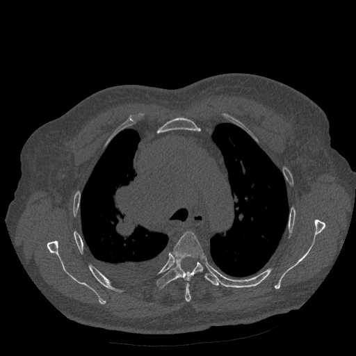 Bronchogenic carcinoma with metastatic lymphadenopathy (Radiopaedia 37671-39569 Axial bone window 17).jpg