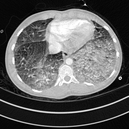 Bronchogenic cyst (Radiopaedia 77801-90071 Axial lung window 65).jpg