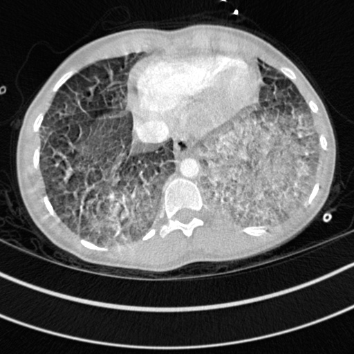 Bronchogenic cyst (Radiopaedia 77801-90071 Axial lung window 67).jpg