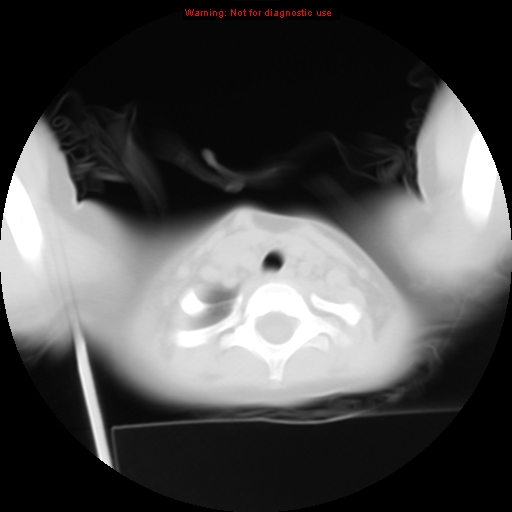 File:Bronchogenic cyst (Radiopaedia 9372-10063 Axial lung window 1).jpg