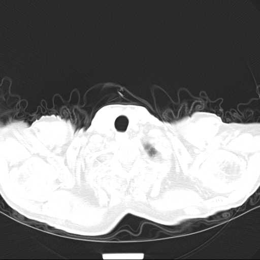Bronchopleural fistula - postoperative complication (Radiopaedia 21020-20947 Axial lung window 1).jpg