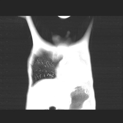 File:Bronchopleural fistula secondary to tuberculosis (Radiopaedia 20415-20322 Coronal lung window 3).jpg