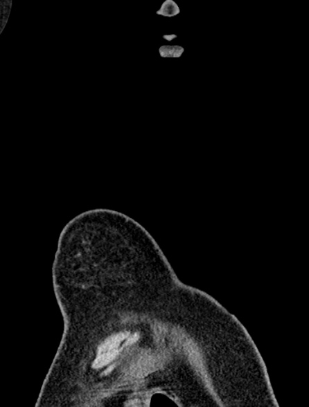 Bronchus suis (Radiopaedia 39631-41953 Coronal non-contrast 4).jpg