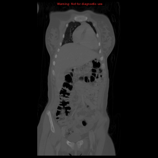 File:Brown tumor (Radiopaedia 12318-12596 D 21).jpg
