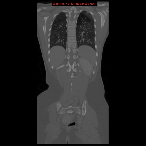 File:Brown tumor (Radiopaedia 12318-12596 D 51).jpg