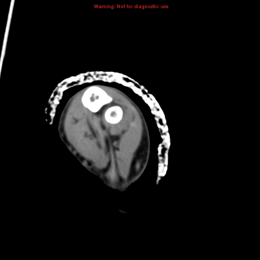 Brown tumor (Radiopaedia 12460-12694 Axial non-contrast 123).jpg