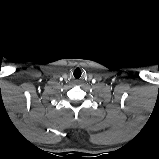 Buccal fat pad arteriovenous malformation (Radiopaedia 70936-81144 D 73).jpg