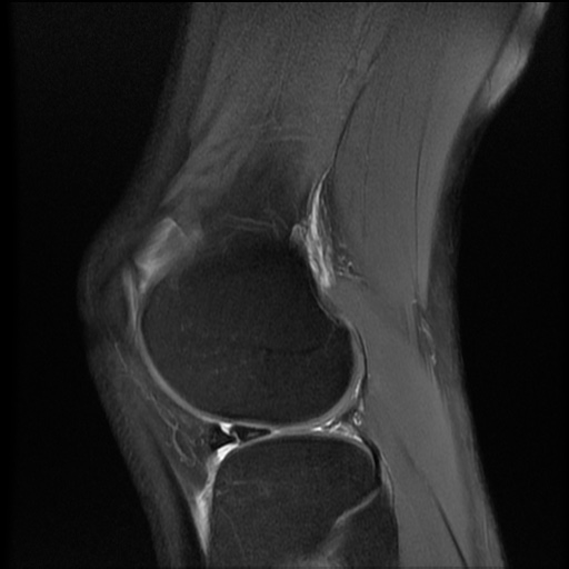 File:Bucket-handle meniscus tear (Radiopaedia 65700-74809 Sagittal PD fat sat 17).jpg