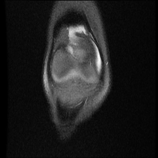 File:Bucket handle tear - lateral meniscus (Radiopaedia 72124-82634 Coronal PD fat sat 3).jpg