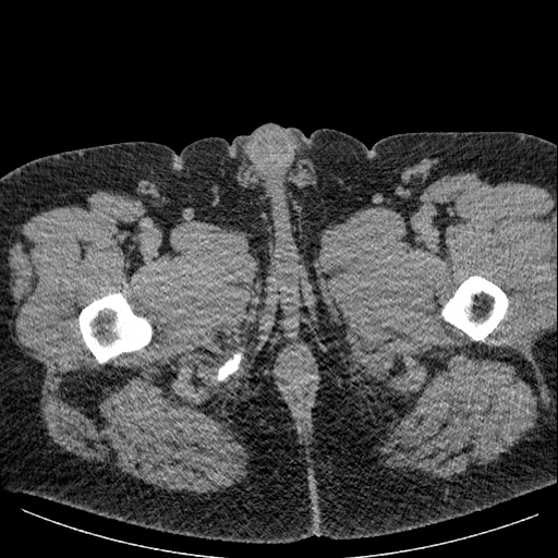 File:Burned-out testicular seminoma - retroperitoneal nodal metastases (Radiopaedia 62872-71245 A 79).jpg
