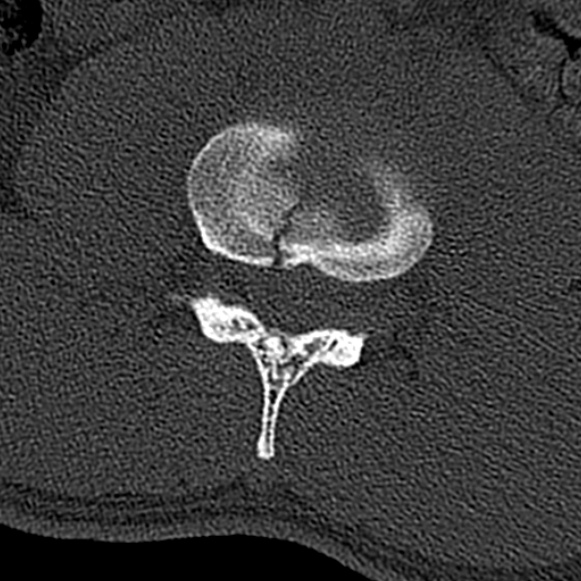 File:Burst fracture (Radiopaedia 53373-59357 Axial bone window 37).jpg
