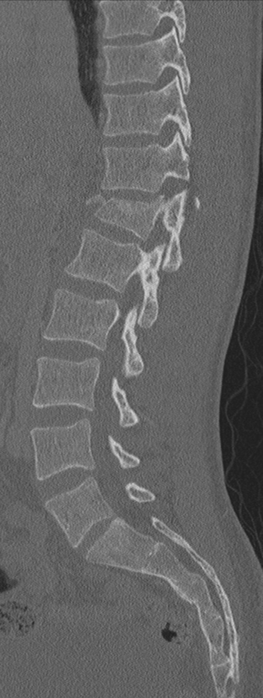 Burst fracture - T12 with conus compression (Radiopaedia 56825-63647 Sagittal bone window 49).png