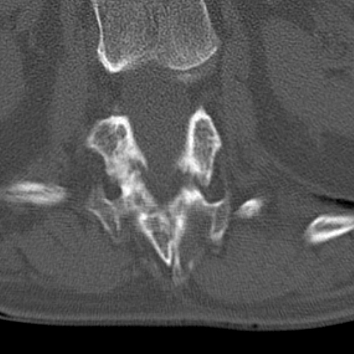Butterfly vertebrae with kyphoscoliosis (Radiopaedia 14257-14133 Axial bone window 68).jpg