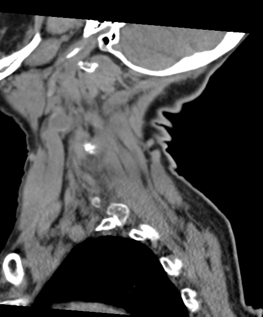 C2 fracture with vertebral artery dissection (Radiopaedia 37378-39199 D 18).png