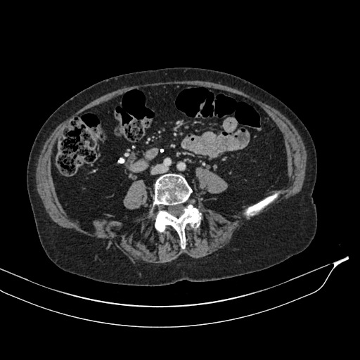 Calcified adrenal glands and Spigelian hernia (Radiopaedia 49741-54988 A 134).jpg