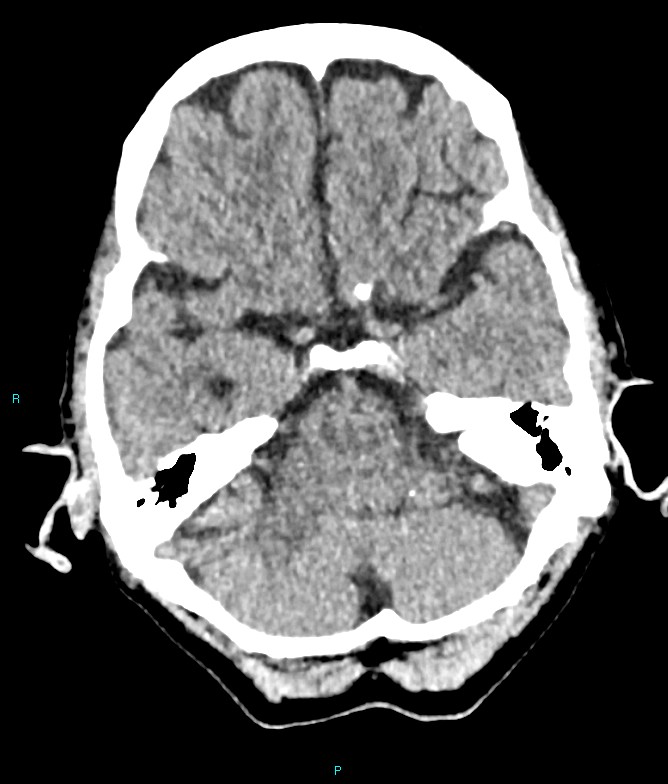 Calcified cerebral emboli from left ventricular thrombus (Radiopaedia 84420-99758 Axial non-contrast 69).jpg