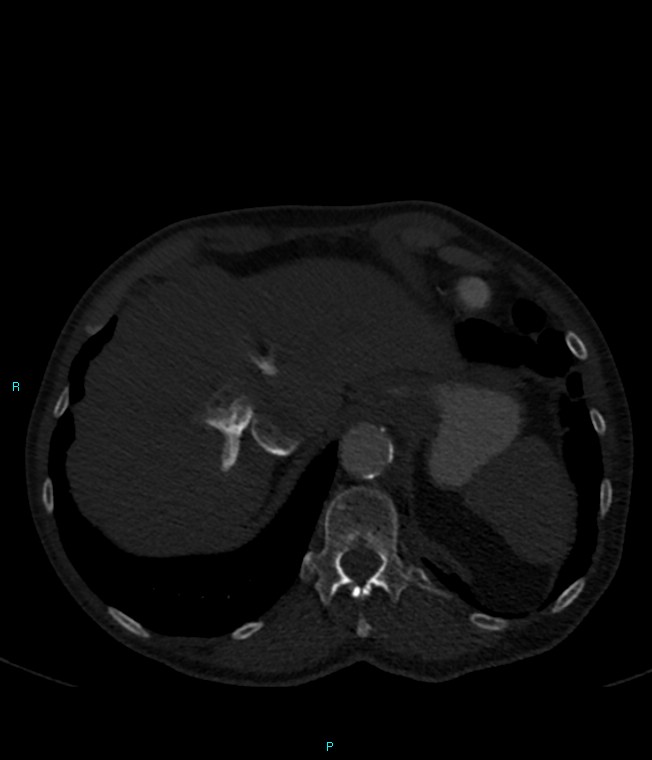 Calcified cerebral emboli from left ventricular thrombus (Radiopaedia 84420-99760 Axial bone window 75).jpg