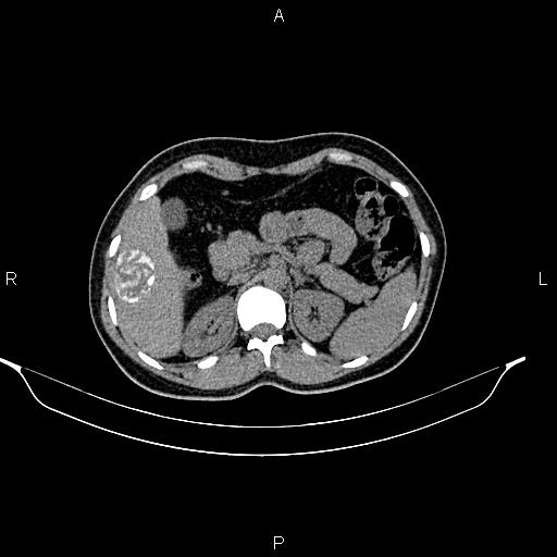 File:Calcified hepatic hydatid cyst (Radiopaedia 84672-100095 Axial non-contrast 33).jpg