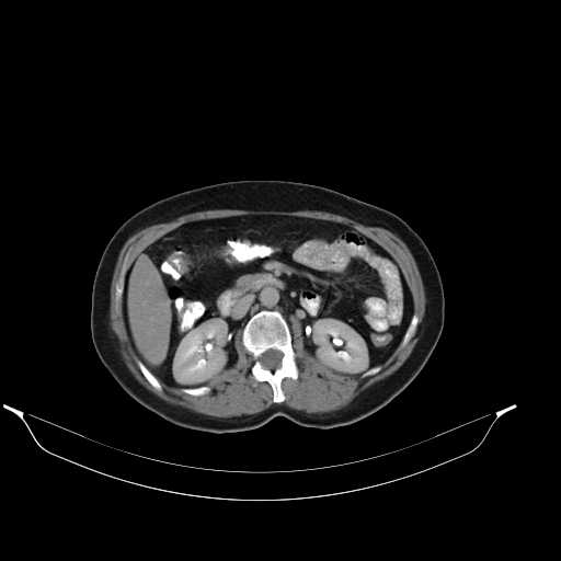 File:Calcified hydatid cyst of the liver (Radiopaedia 21212-21112 Axial C+ delayed 24).jpg