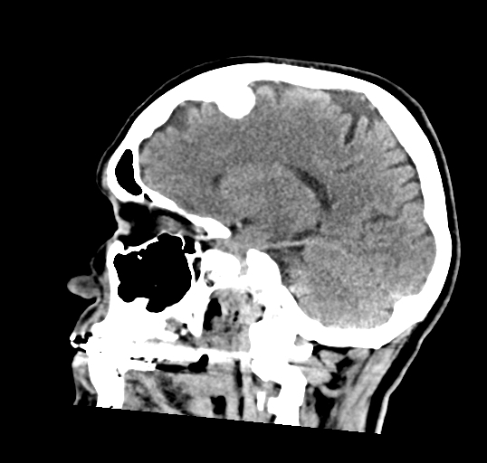 File:Calcified meningioma (Radiopaedia 74361-85243 D 8).jpg
