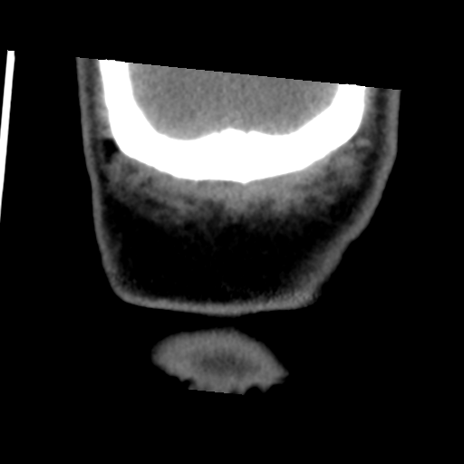 Calcifying pseudoneoplasm of neuraxis (Radiopaedia 44076-47617 Coronal non-contrast 48).png