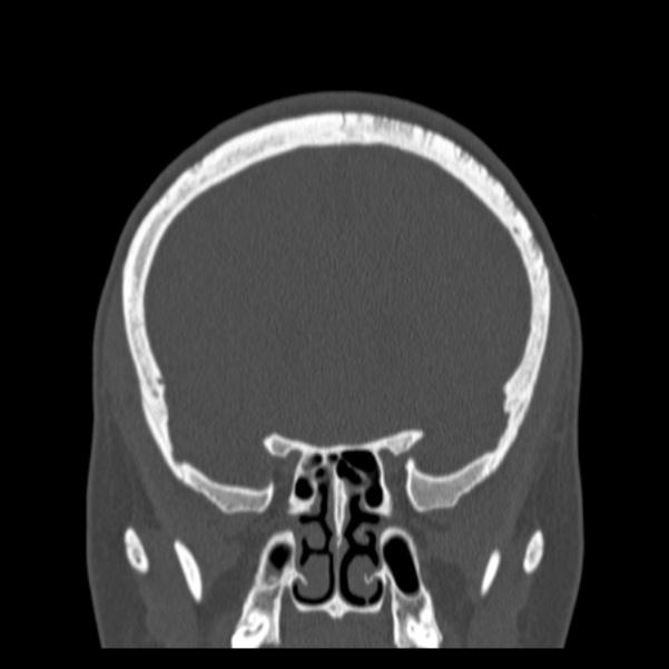 Calvarial osteoma (Radiopaedia 36520-38079 C 32).jpg